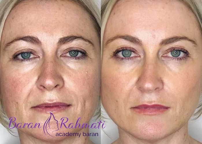 کاندیدای لیفت صورت با نخ