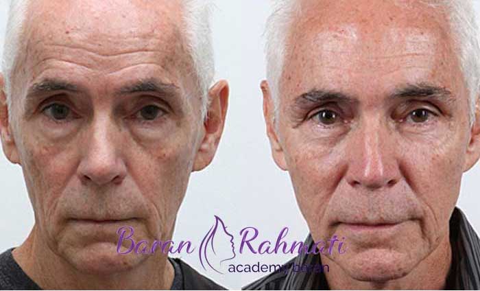 مراقبت‌ های قبل و بعد از تزریق چربی به صورت آقایان