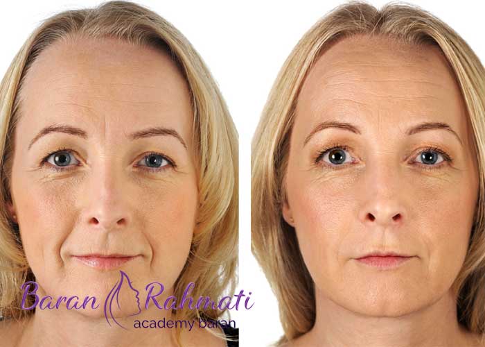 ماندگاری ژل خط خنده چقدر است؟