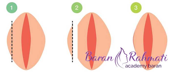 روش برش خطی لابیاپلاستی