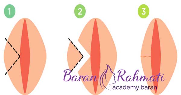لابیاپلاستی به روش برش V شکل