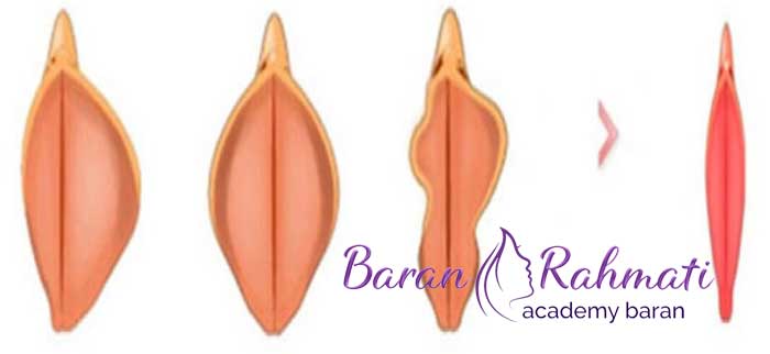 روش لابیاپلاستی با آر اف