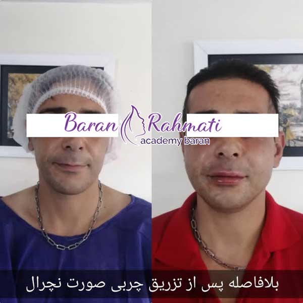مدت ماندگاری تزریق چربی به صورت آقایان