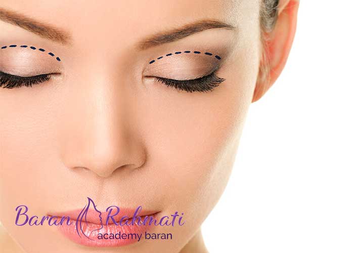 مزایای بلفاروپلاستی