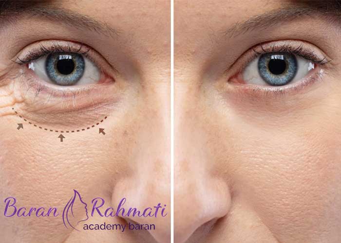 دوره های آموزش بلفاروپلاستی در اصفهان