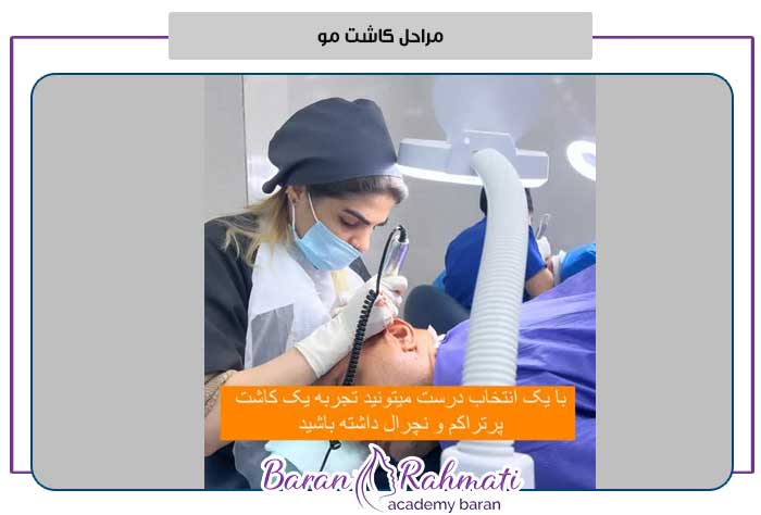مراحل کاشت مو