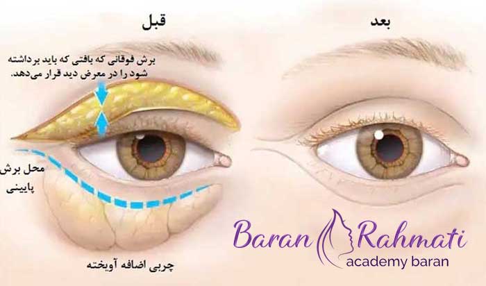 دوره های آموزش بلفاروپلاستی در مشهد