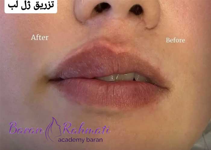 آموزش تزریق ژل در رشت