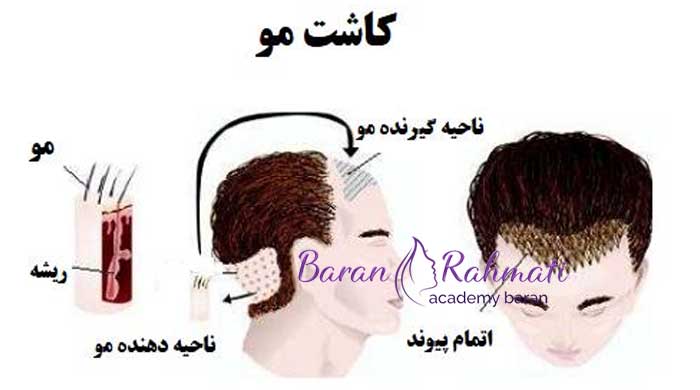 روش ‌های کاشت مو