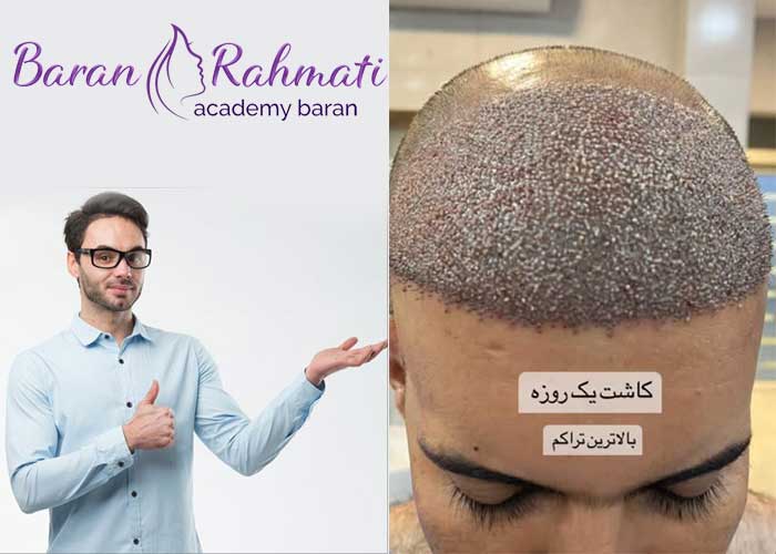 Read more about the article آموزش کاشت مو در اصفهان