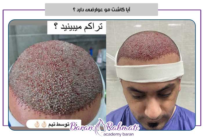 معایب و عوارض کاشت مو