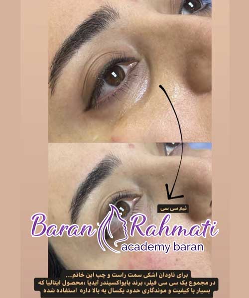 آموزش تزرق فیلر چشم