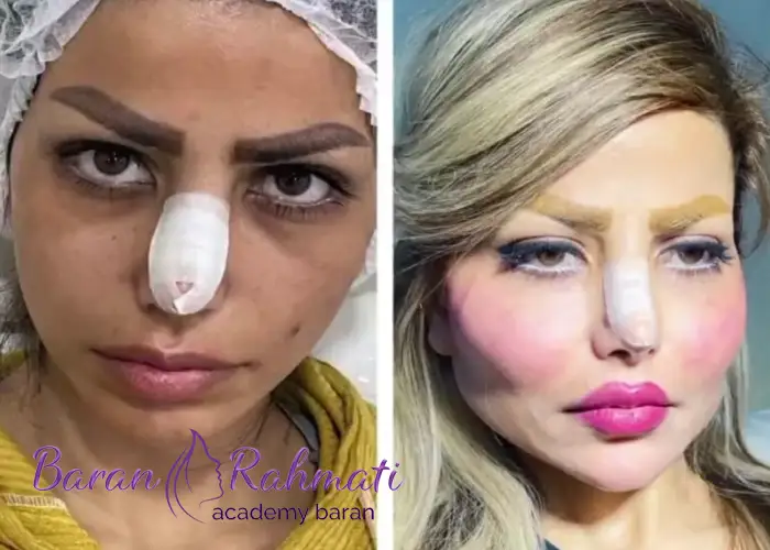 تزریق چربی در اصفهان