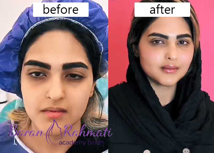 Read more about the article آموزش تزریق چربی در شیراز