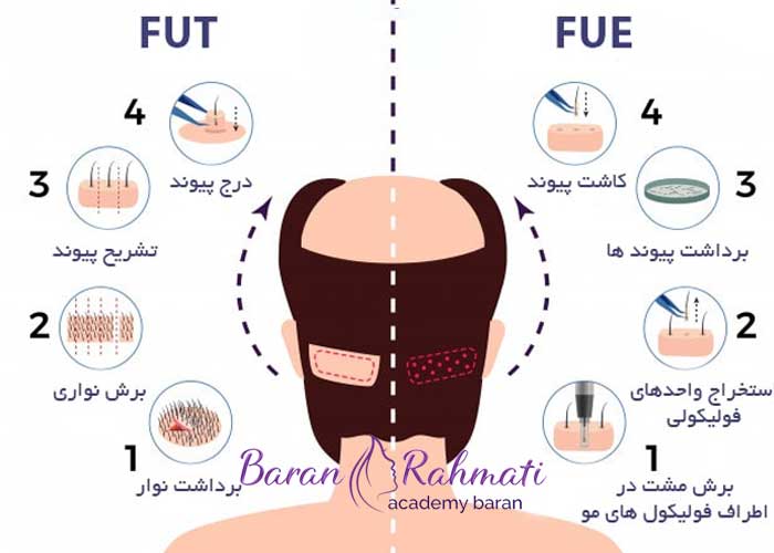 آموزش کاشت مو fue,fut