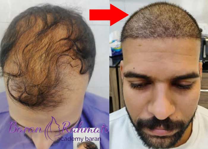 Read more about the article آموزش کاشت مو در شیراز