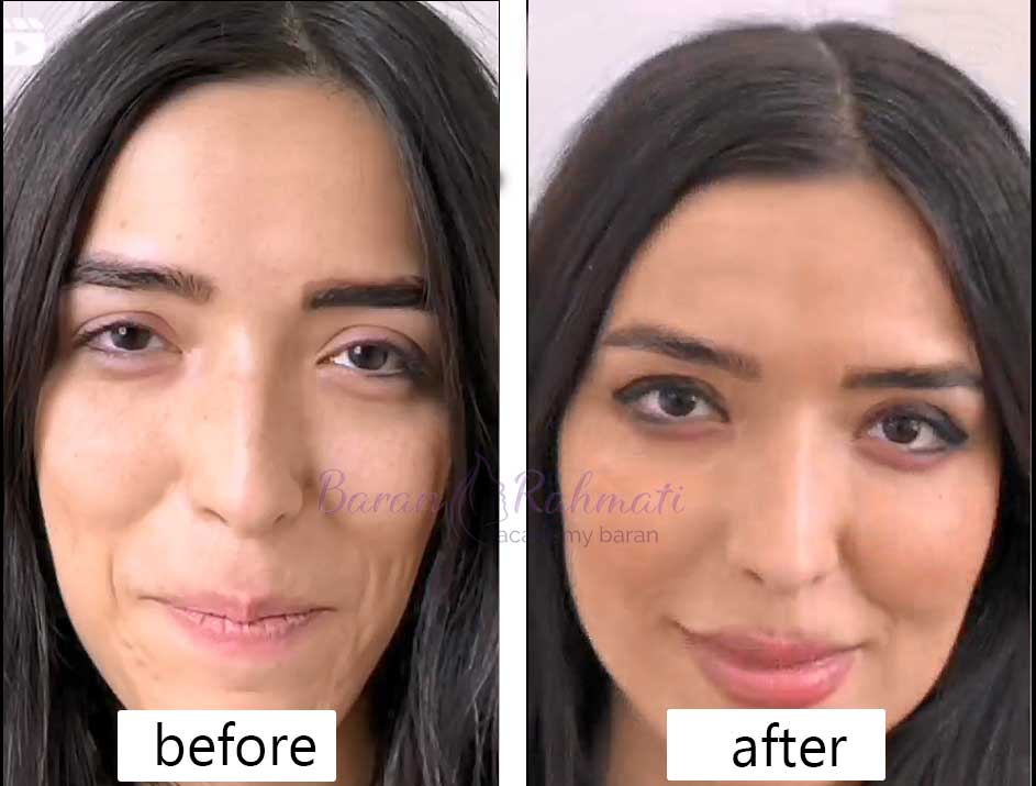 بهترین آموزشگاه تزریق چربی به صورت در شیراز