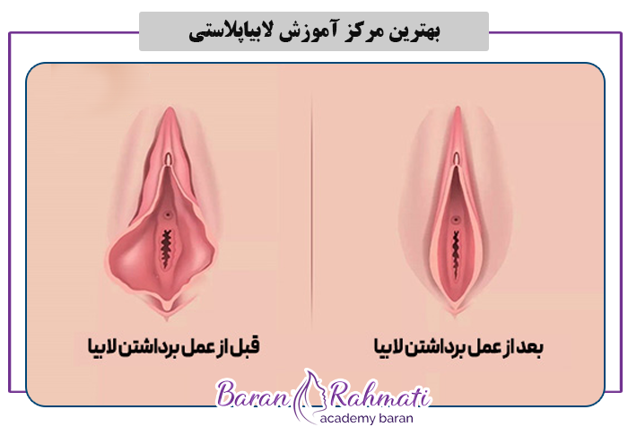 بهترین مرکز آموزش لابیاپلاستی