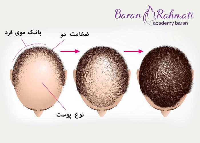 دوره آموزش کاشت مو در رشت