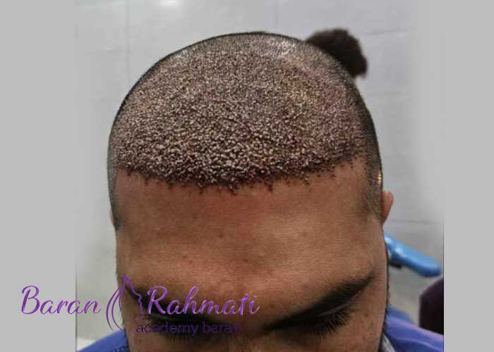 Read more about the article آموزش کاشت مو در رشت