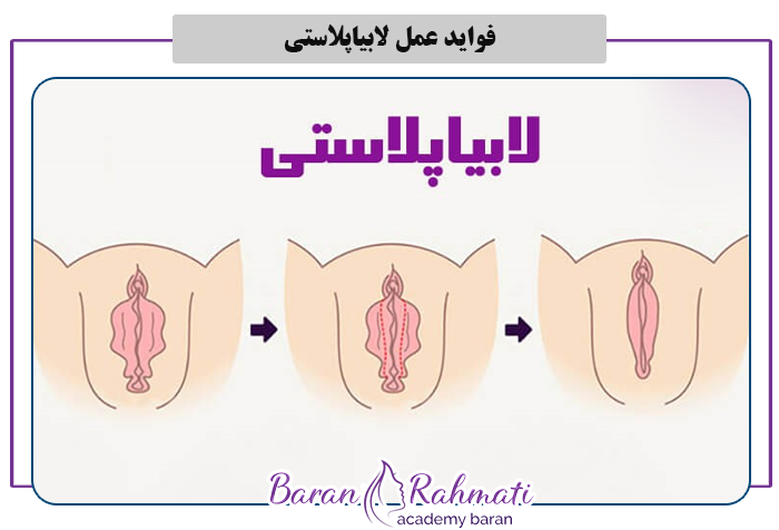 فواید عمل لابیاپلاستی