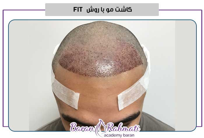 کاشت مو با روش FIT
