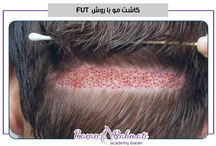 کاشت مو با روش FUT