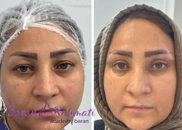 Read more about the article آموزش بلفاروپلاستی در شیراز