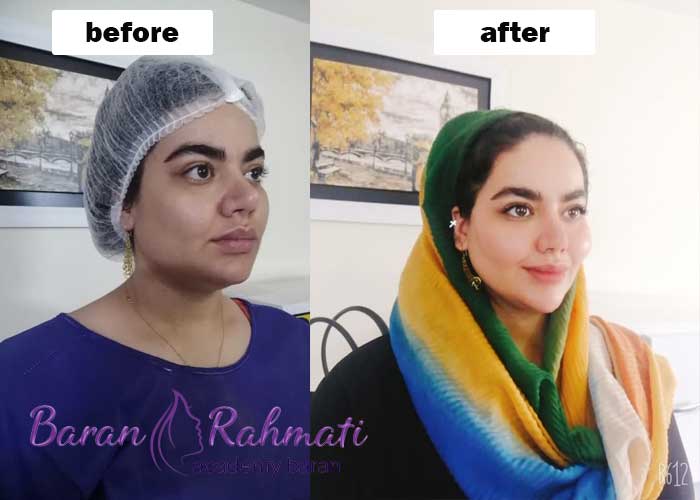 Read more about the article آموزش تزریق چربی در رشت