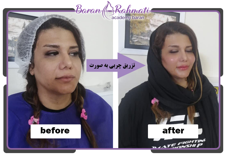 تزریق چربی به صورت در رشت