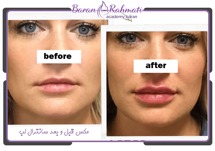 عکس قبل و بعد سانترال لب