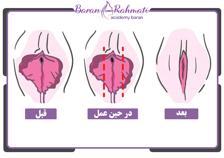 قیمت آموزش لابیاپلاستی در یزد