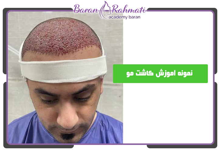 قیمت آموزش کاشت مو در تبریز