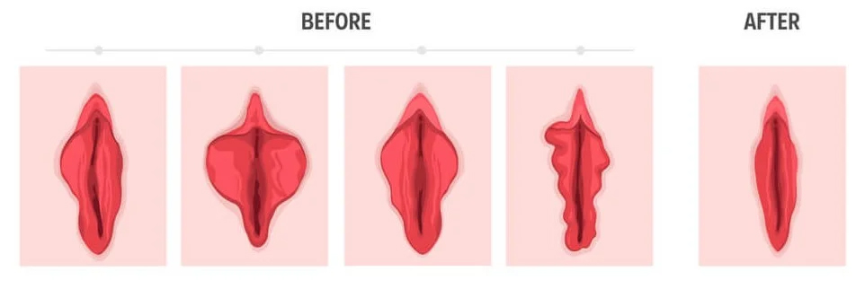 عمل زیبایی واژن قبل و بعد