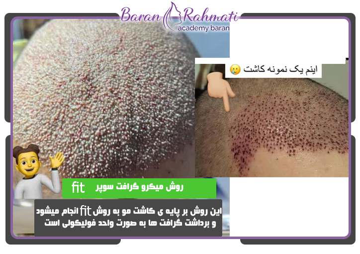 نمونه آموزش کاشت مو در تبریز