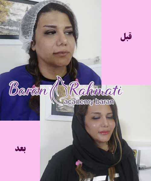 آموزش تزریق چربی
