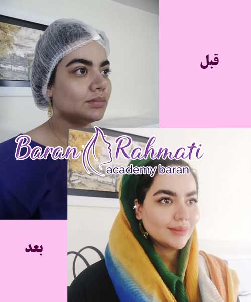 آموزش تزریق چربی