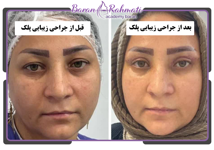 قبل و بعد جراحی زیبایی پلک