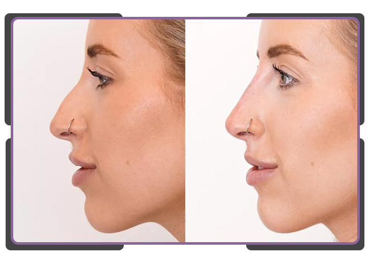 آموزش کوچک کردن بینی با فیلر