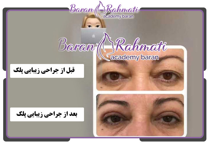 قبل و بعد بلفاروپلاستی پلک