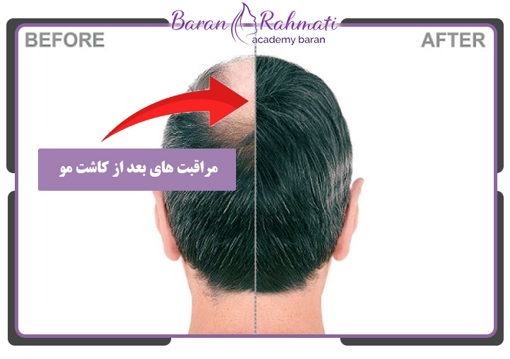 مراقبت های بعد از کاشت مو 