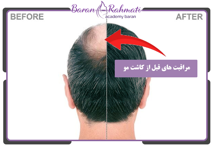 مراقبت های قبل از کاشت مو 