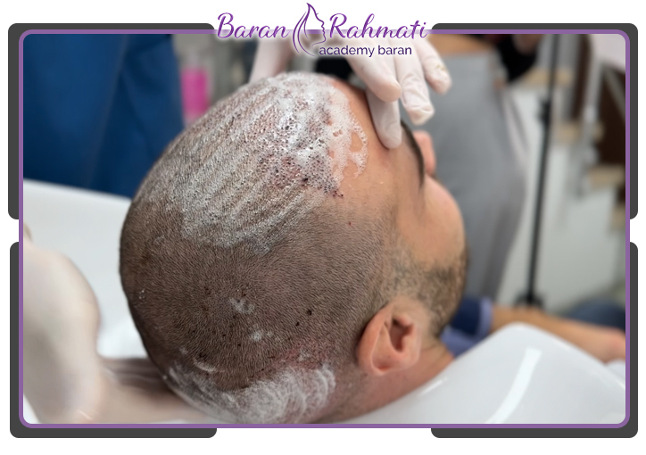 نحوه ی شست و شو بعد از کاشت مو