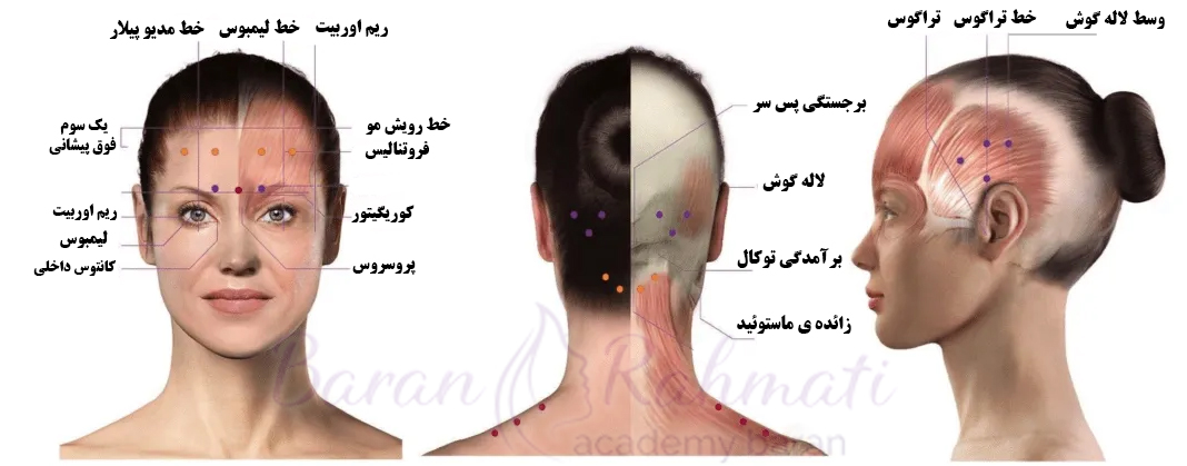 نقاط تزریق بوتاکس برای میگرن