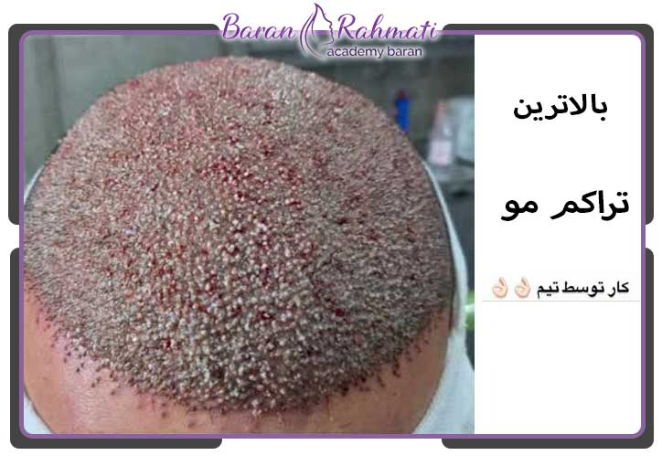 آموزش نحوه ی کاشت مو در اهواز