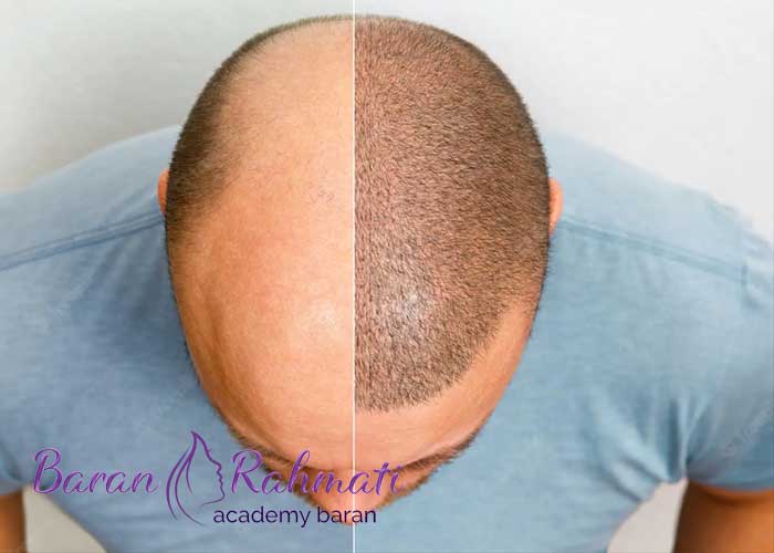 Read more about the article آموزش کاشت مو در تهران