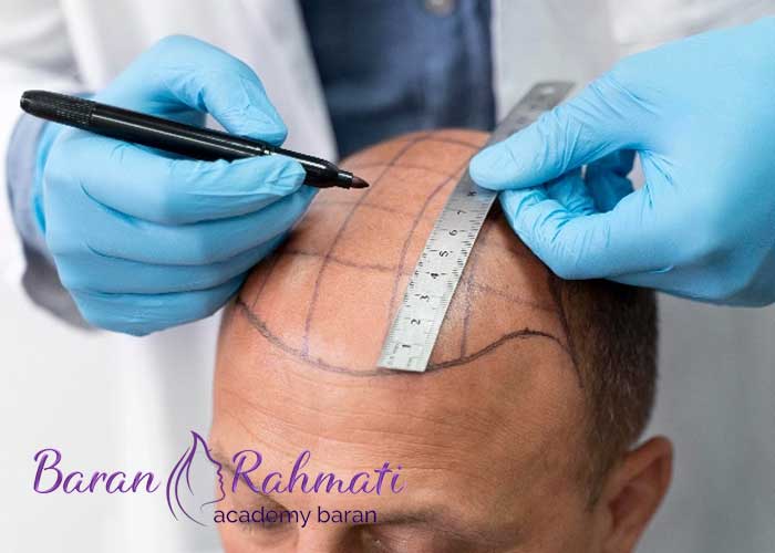 Read more about the article آموزش کاشت مو در اهواز