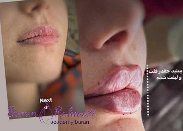 Read more about the article تفاوت بین ژل لب روسی و معمولی