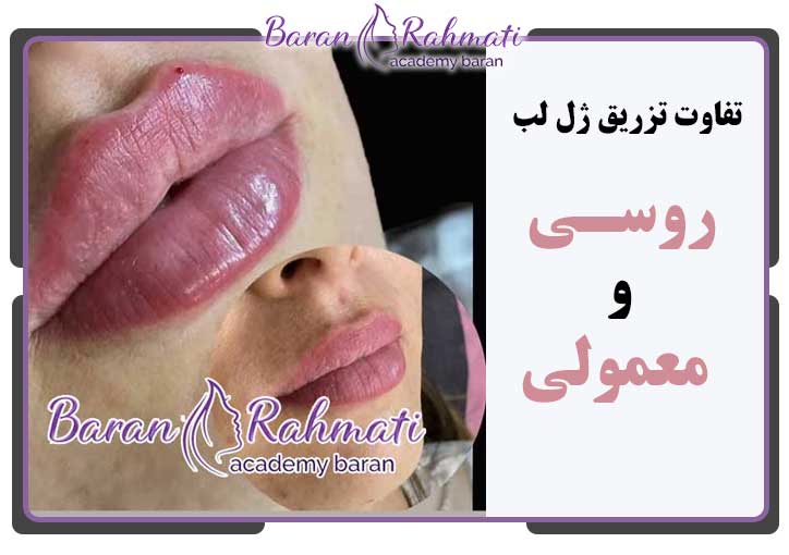 تفاوت بین ژل لب روسی و معمولی