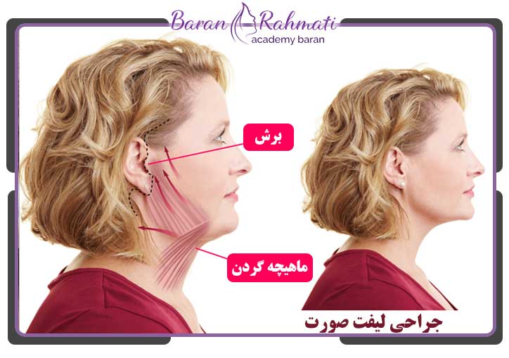 جراحی لیفت صورت